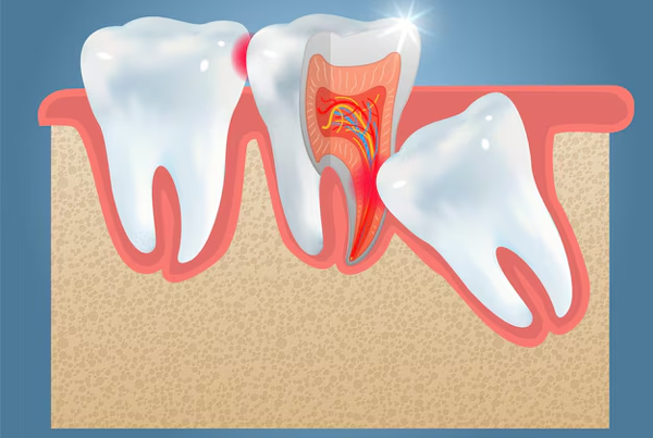 Wisdom Tooth Removal