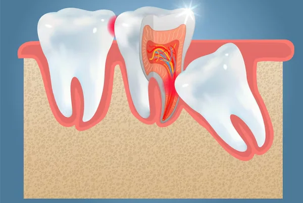 Wisdom Tooth Removal
