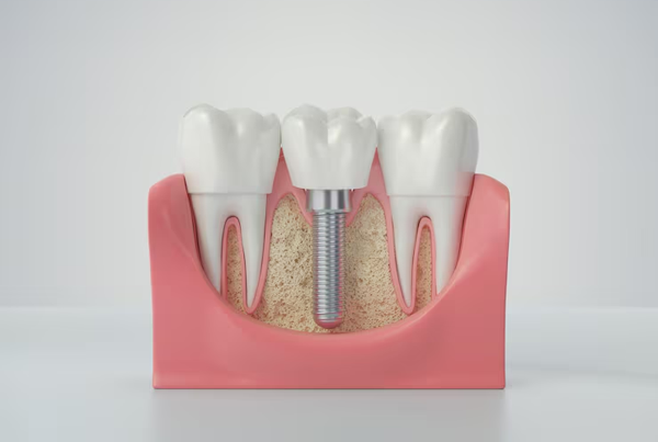 Dental Implant Treatment