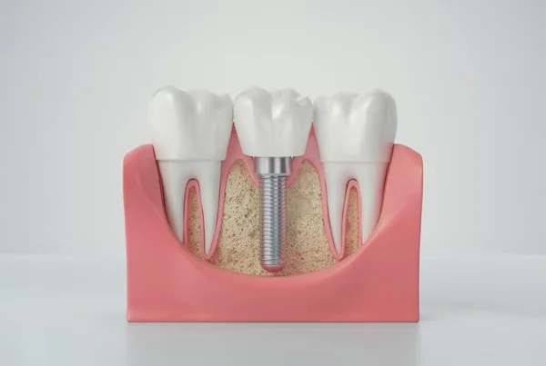 Dental Implant Treatment